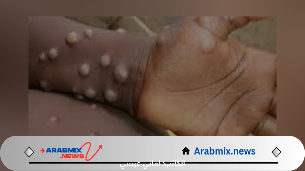 جدري القرود في العراق.. وزارة الصحة توضح حقيقة إنتشار الفيروس